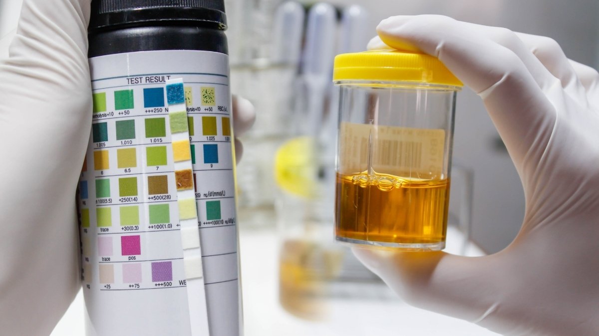 Breaking: This Common Urine Color Signals You Have, You are in Great Health Disease